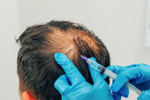 expert hair transplants 0000 prp therapy
