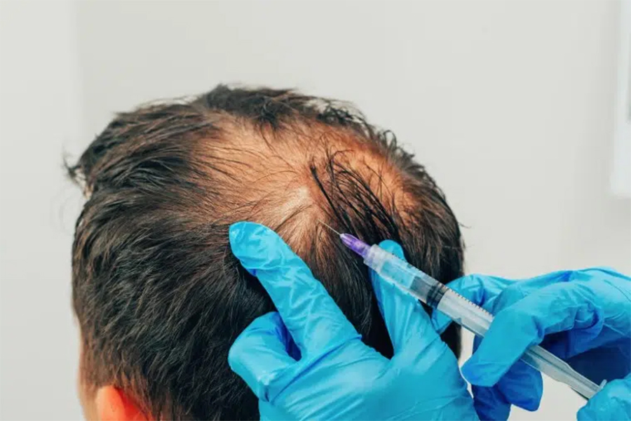 expert hair transplants 0000 prp therapy expert hair transplants 0000 prp therapy
