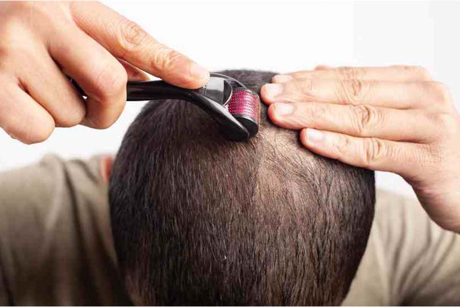 expert hair transplants 0003 mesotherapy expert hair transplants 0003 mesotherapy